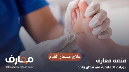 علاج مسمار القدم نهائيا