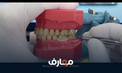 RelyX Ultimate clicker cementation of glass ceramic crown with tack cure  technique 